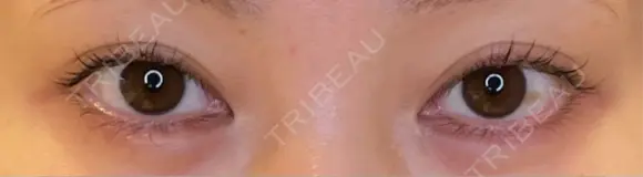 目尻切開 / タレ目形成・グラマラスライン（埋没） LOUIS CLINIC 二子玉川院【ルイクリニック】 BEFORE メイン用