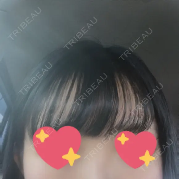 ヒアルロン酸注入（鼻） 広島プルミエクリニック BEFORE メイン用