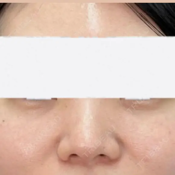 クマ治療 / ヒアルロン酸注入（目の下） ROOTS Clinic BEFORE メイン用