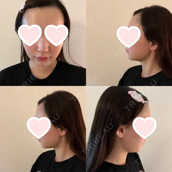 ヒアルロン酸注入（鼻翼基部） / その他（鼻） ルラ美容クリニック 渋谷本院 BEFORE メイン用