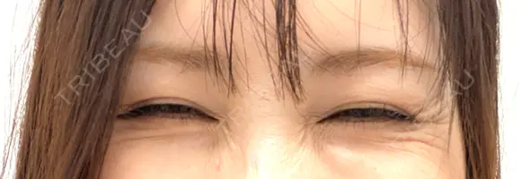 ボトックス（目尻） TCB東京中央美容外科 枚方院 BEFORE メイン用