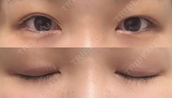 二重埋没 水の森美容クリニック 大阪梅田院 BEFORE メイン用