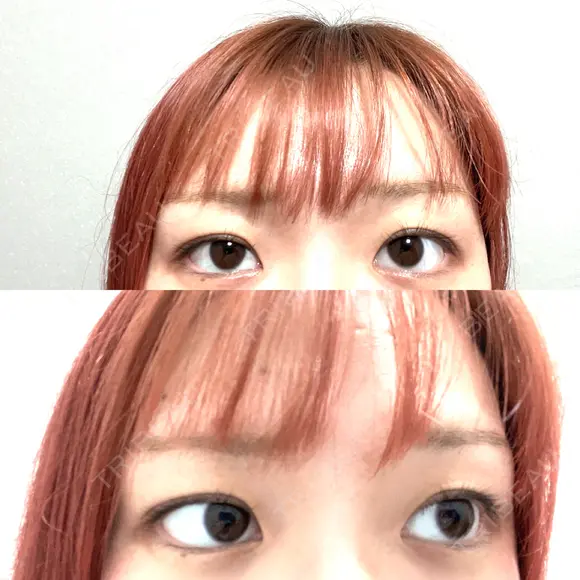 二重埋没 ROOTS Clinic BEFORE メイン用