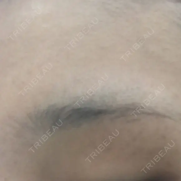 医療脱毛（顔） LIFIX BEAUTY CLINIC BEFORE メイン用