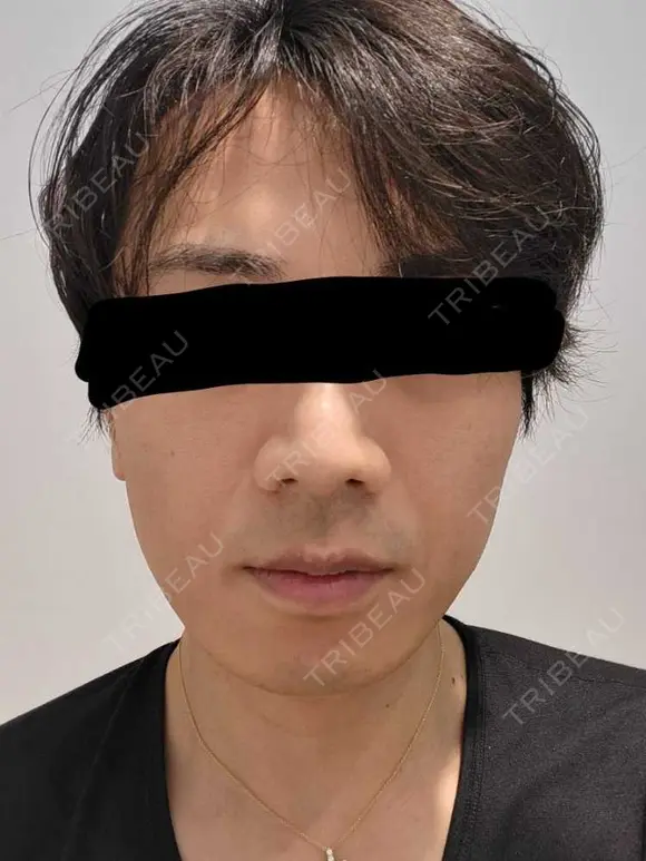 医療脱毛（顔） ミラクリニック 池袋院 BEFORE メイン用