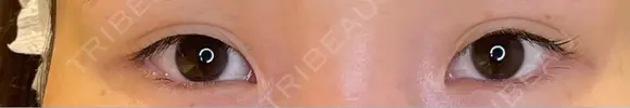 目尻切開 / タレ目形成・グラマラスライン（埋没） LOUIS CLINIC 二子玉川院【ルイクリニック】 BEFORE メイン用