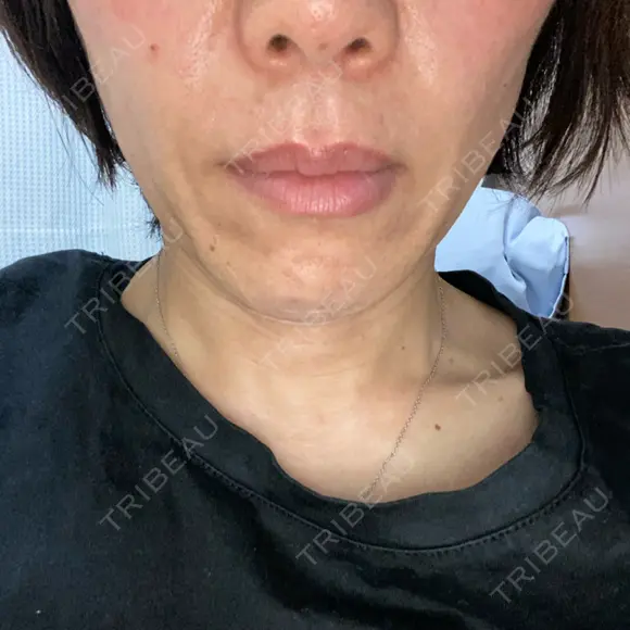 人中短縮 / 口角挙上 / その他（口元） ルラ美容クリニック 神戸院 BEFORE メイン用