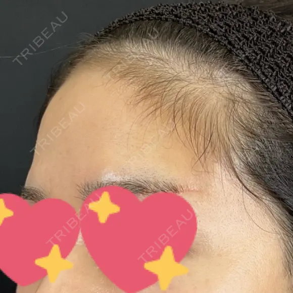 ヒアルロン酸注入（額） 藤・ナチュレ美容クリニック 銀座院 BEFORE メイン用