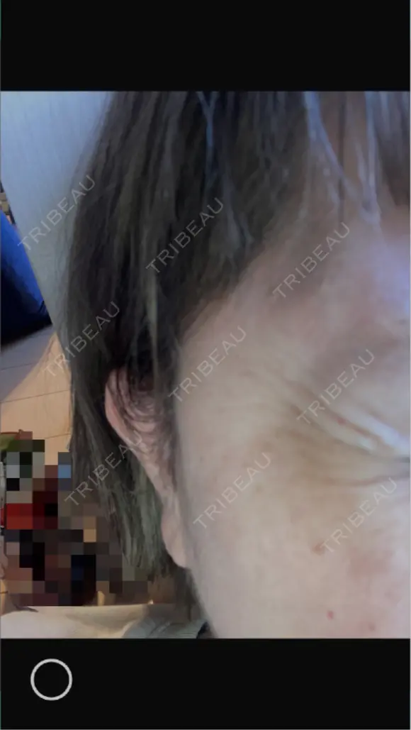 ボトックス（目尻） ROOTS Clinic BEFORE メイン用