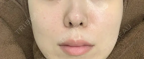 水光注射（ハリ・美肌） / その他（肌） / リジュラン ゆきスキンクリニック 東池袋 BEFORE メイン用