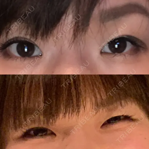 二重埋没 メディカルビューティセンター BEFORE メイン用