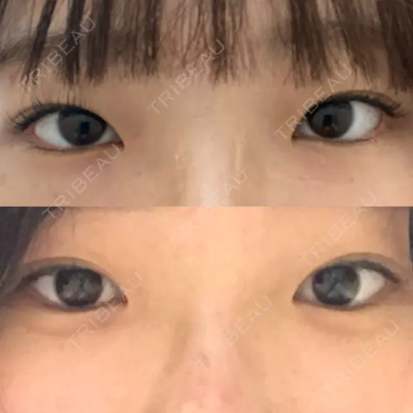 目頭切開 くさのたろうクリニック BEFORE メイン用
