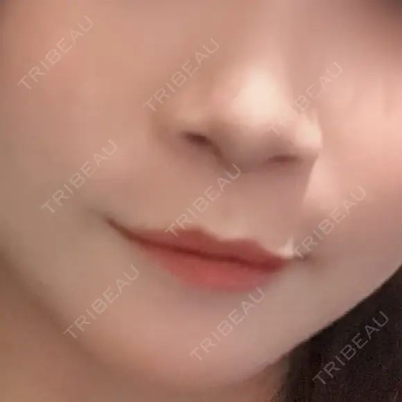 人中短縮 / 目尻切開 / タレ目形成・グラマラスライン（切開） / ボトックス（人中） / その他（鼻） ルラ美容クリニック 大阪本院 BEFORE メイン用