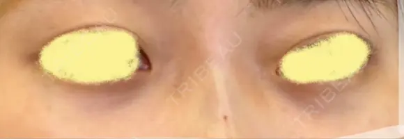 リジュラン 渋谷美容外科クリニック 横浜院 BEFORE メイン用