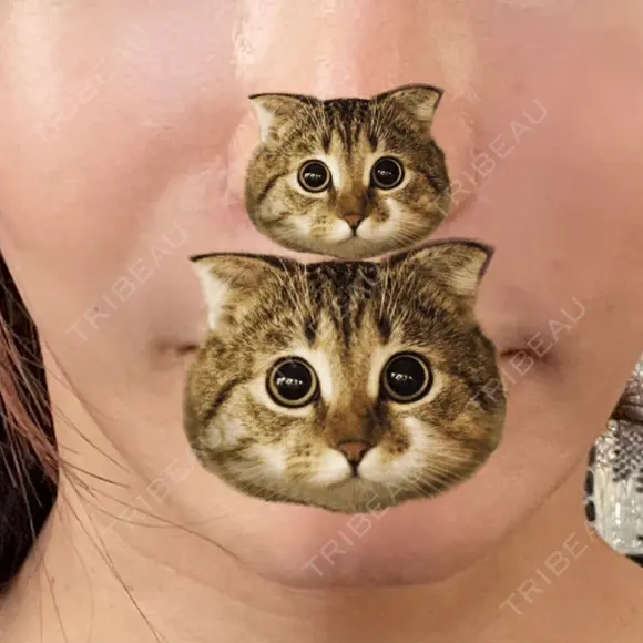 切開リフト 東京エビスクリニック BEFORE メイン用