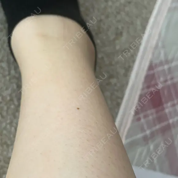 ほくろ・いぼ除去レーザー（肌） 心斎橋KT美容クリニック BEFORE メイン用