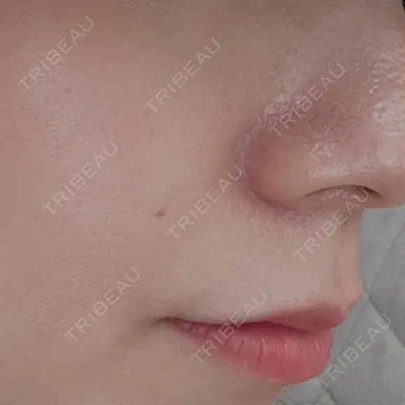 ボトックス（エラ・小顔） / その他（口元） 共立美容外科 福岡院 BEFORE メイン用