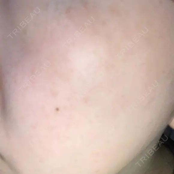 光治療（フォトフェイシャルなど） 共立美容外科 仙台院 BEFORE メイン用