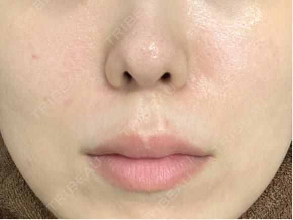 レーザーフェイシャル LIGHT CLINIC 【ライトクリニック】 新宿院 BEFORE メイン用