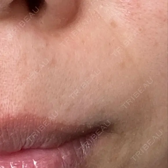 肌ヒアルロン酸注入（たるみ・シワ改善） TCB東京中央美容外科 姫路院 BEFORE メイン用