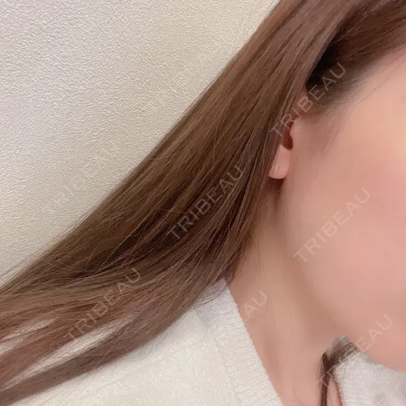 ボトックス（エラ・小顔） ミニマムスキンクリニック池袋 BEFORE メイン用