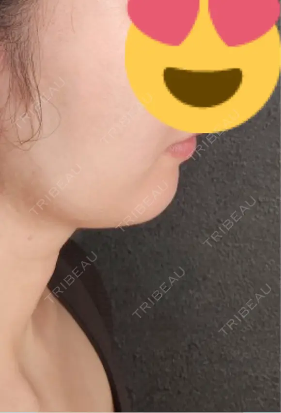 ヒアルロン酸注入（あご） Tokyo Tensei Clinic 銀座院 BEFORE メイン用