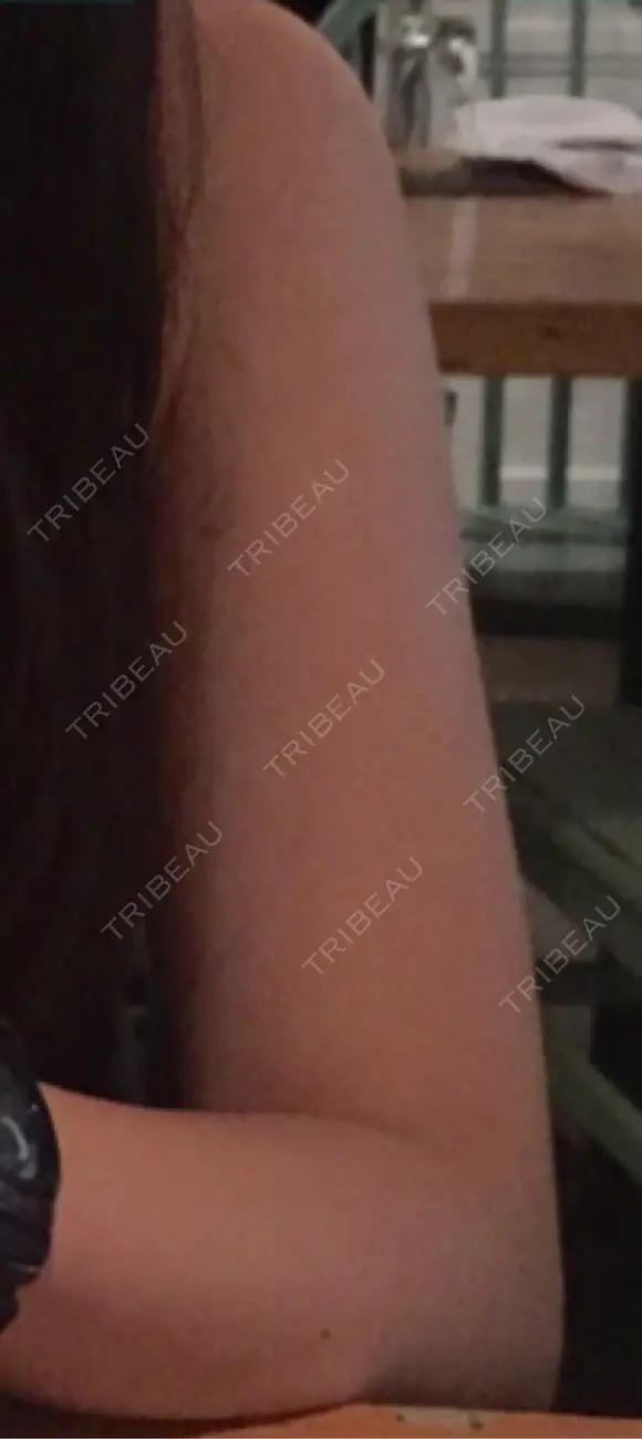 脂肪冷却（二の腕） LE CLINIC BEFORE メイン用