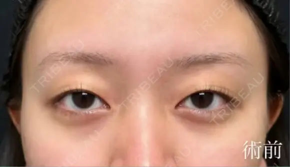 二重埋没 湘南美容クリニック 博多院 BEFORE メイン用