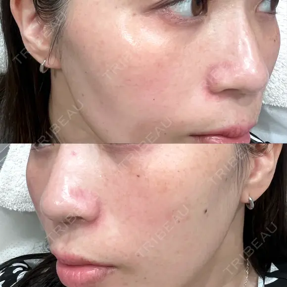 シミ取りレーザー / ピコレーザートーニング（美白・肝斑） PRISM Beauty Clinic 町田院 BEFORE メイン用
