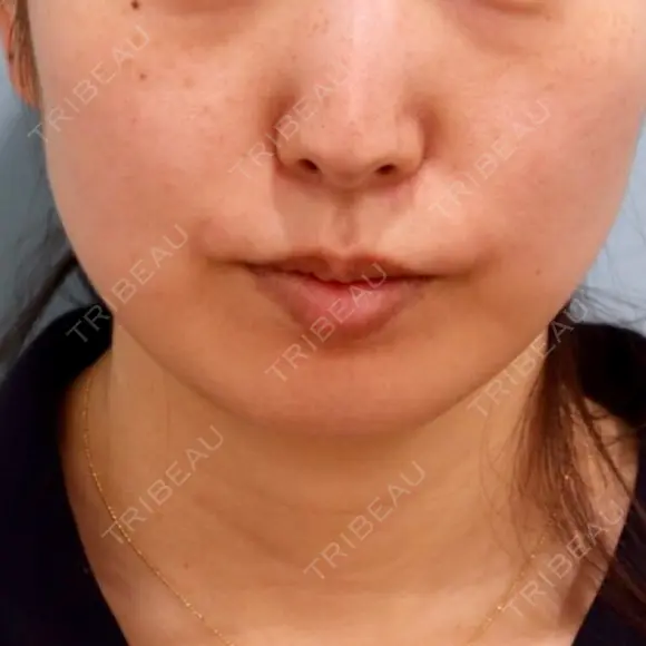 脂肪溶解注射（顔） ビクアスクリニック BEFORE メイン用