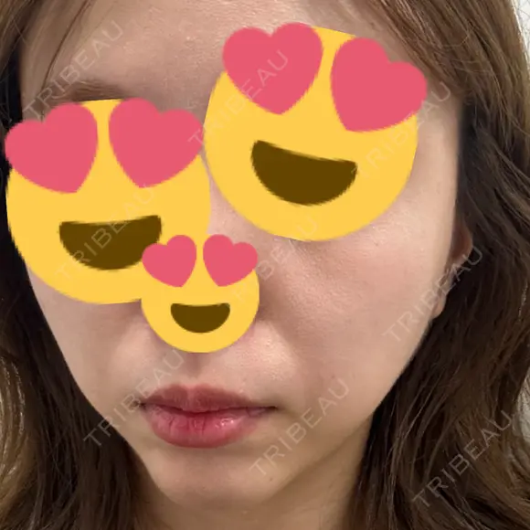 ピコレーザートーニング（美白・肝斑） / ピコフラクショナルレーザー（毛穴・ニキビ跡） BISIN GINZA CLINIC BEFORE メイン用