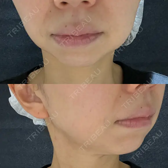 糸リフト / ジョールファット除去 吉祥寺アイビークリニック BEFORE メイン用