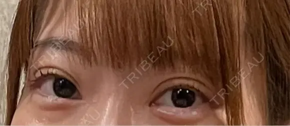 クマ治療 / タレ目形成・グラマラスライン（切開） 池袋麗歯科・美容皮膚科 BEFORE メイン用