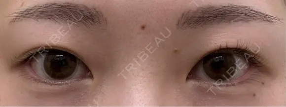 二重埋没 / 上まぶたの脂肪取り 湘南美容クリニック 京都院 BEFORE メイン用