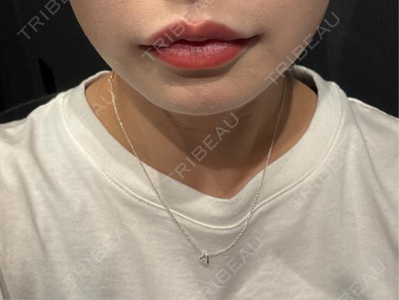 ヒアルロン酸注入（唇） Code Beauty Clinic 名古屋院 BEFORE メイン用