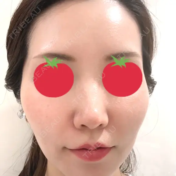 ヒアルロン酸注入（鼻） / ヒアルロン酸注入（唇） / ヒアルロン酸注入（頬） / ヒアルロン酸注入（こめかみ） BIANCA銀座 BEFORE メイン用