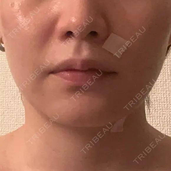 その他（輪郭） 表参道メディカルクリニック 銀座院 BEFORE メイン用