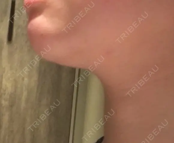 脂肪溶解注射（顔） / PRP皮膚再生療法 聖心美容クリニック 六本木院 BEFORE メイン用