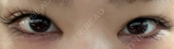 自然癒着法 シンデレラ＆ダヴィンチクリニック BEFORE メイン用