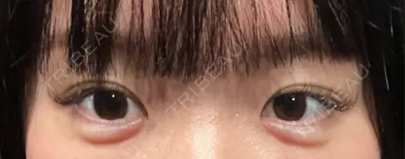 ヒアルロン酸溶解 Code Beauty Clinic 名古屋院 BEFORE メイン用