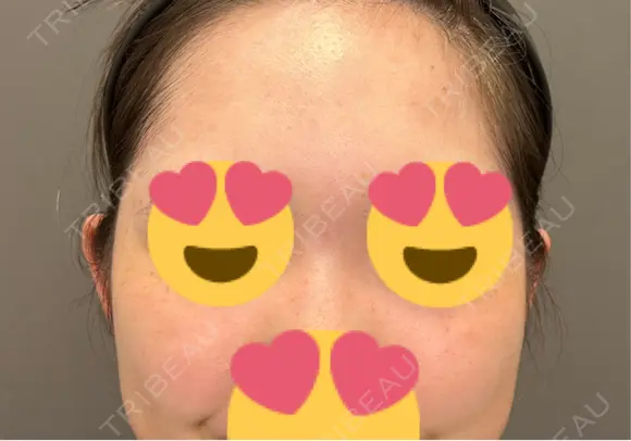 毛穴洗浄（ハイドラフェイシャルなど） / ピコレーザートーニング（美白・肝斑） アーククリニック BEFORE メイン用