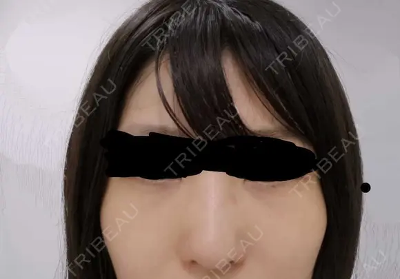 シミ取りレーザー / その他（目元） 共立美容外科 仙台院 BEFORE メイン用