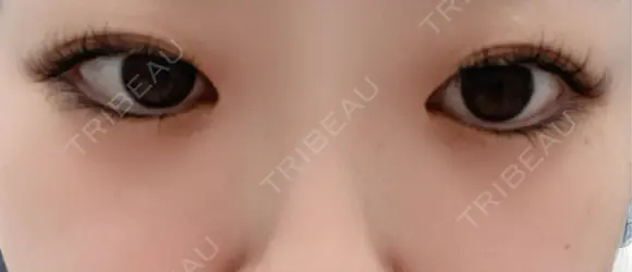 二重埋没 東京シンデレラ美容外科 大宮院 BEFORE メイン用