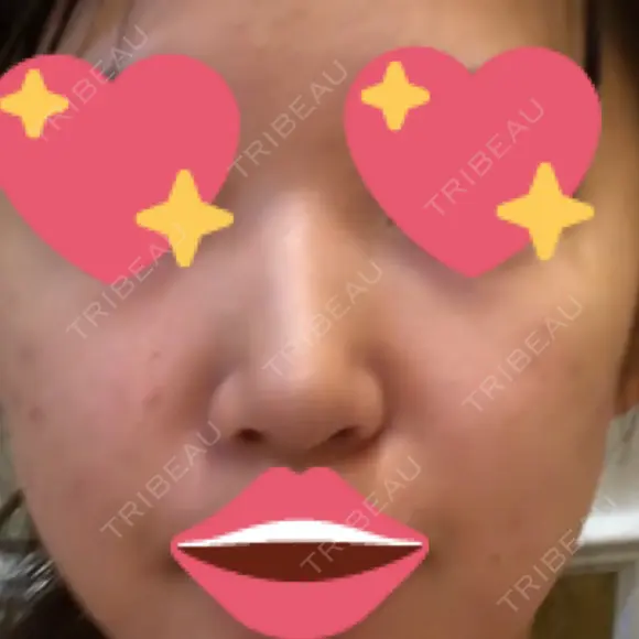 隆鼻術 / 鼻尖形成（切開） / 軟骨移植 / 骨切幅寄せ / ワシ鼻修正・ハンプ切除 / 斜鼻修正 / 鼻修正 韓国BBクリニック（旧 シンミアン形成外科） BEFORE メイン用