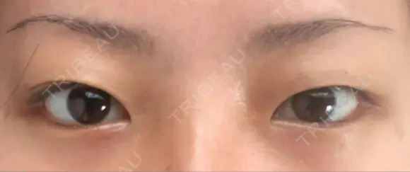 二重埋没 / 隆鼻術 / 上まぶたの脂肪取り クリスタル美容外科 山形院 BEFORE メイン用