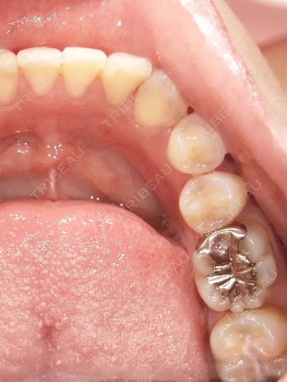 セラミック 東京美容外科 赤坂院 BEFORE メイン用