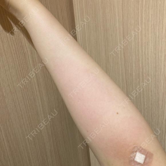 白玉点滴・注射 HAAB BEAUTY CLINIC 名古屋院 BEFORE メイン用