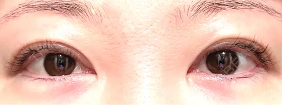 目頭切開 / 目尻切開 EMMA CLINIC（エマクリニック） BEFORE メイン用