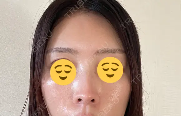 水光注射（ハリ・美肌） オラクル美容皮膚科 東京新宿院 BEFORE メイン用