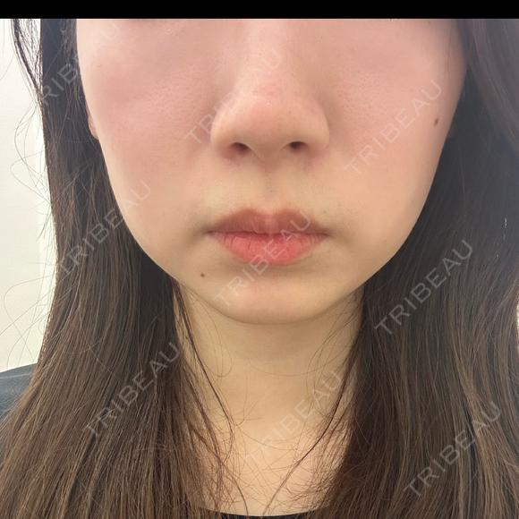 ボトックス（エラ・小顔） TCB東京中央美容外科 福岡博多院 BEFORE メイン用